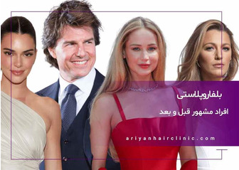 بلفاروپلاستی افراد مشهور قبل و بعد